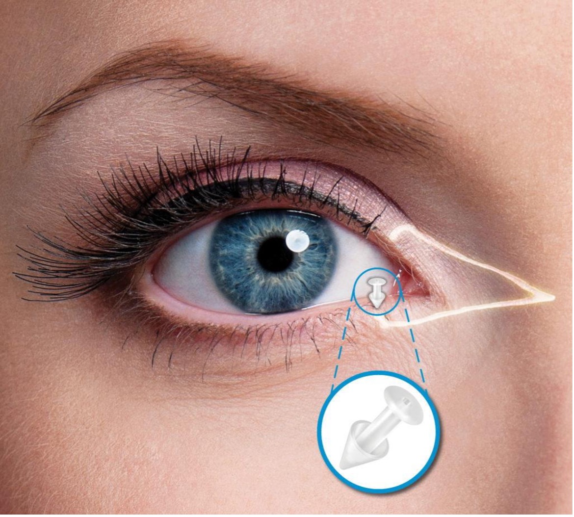 Eye with diagram of a punctal plug and how that is inserted in the inner corner of the eye